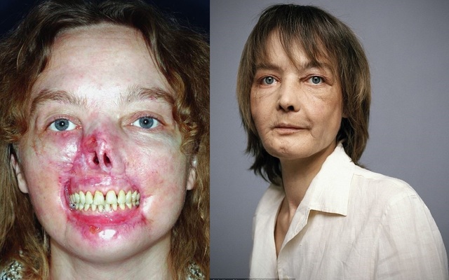 First Partial Face Transplant