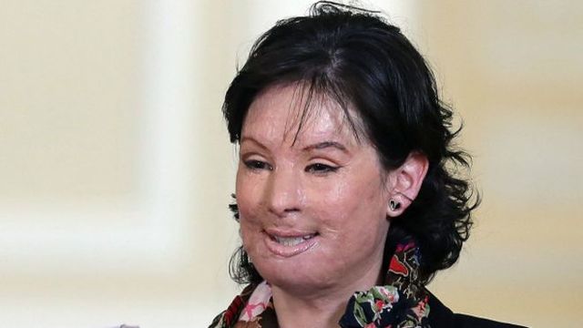 No fue un ataque con ácido más