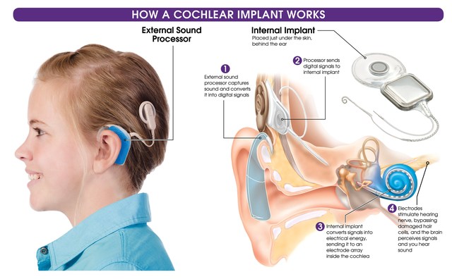 Cochlear Implants Approved