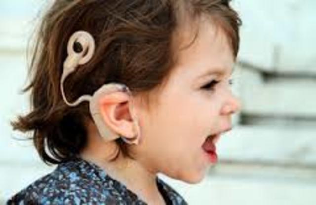 Use of Cochlear Implants increases