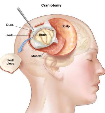 Removal of the Pituitary Tumor.