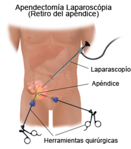 Operación Apendicitis