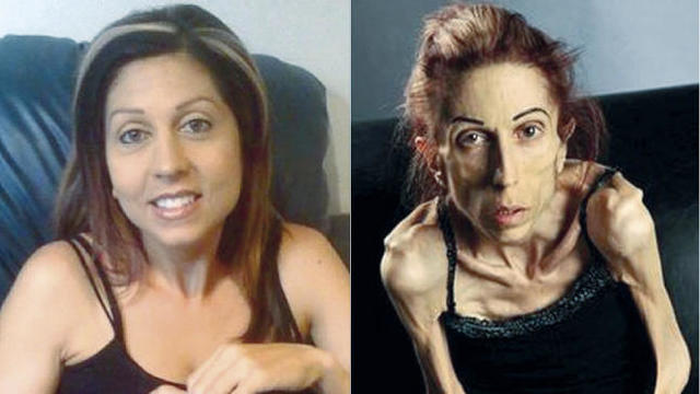 Anorexia ( Actualidad, expuesta en en distintos paises del mundo conocida como un problema social)