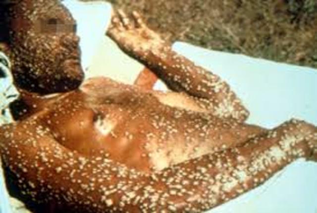 An epidemic of smallpox, brought by Europeans, kills many native Americans on the New England coast