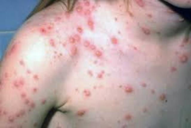 Chickenpox kills many Native Americans along the New England Coast
