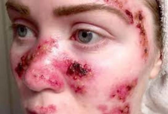 2do Accidente Therac-25