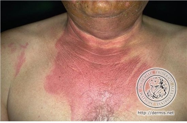 3er Accidente Therac-25