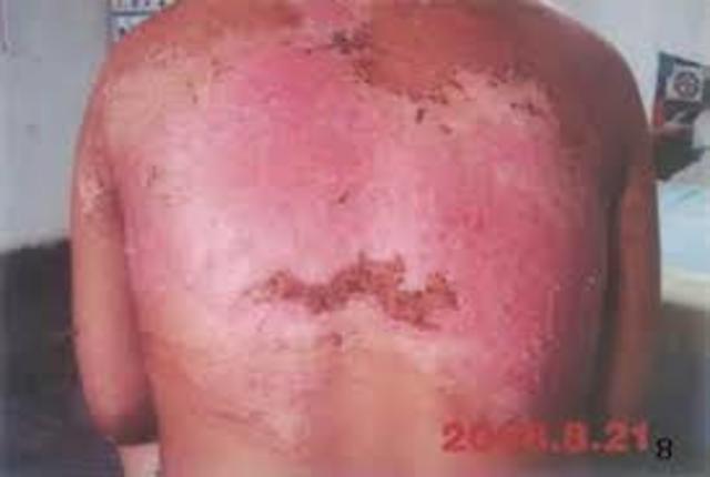 4to Accidente Therac-25