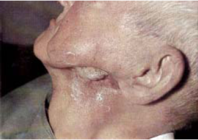 5to Accidente Therac-25