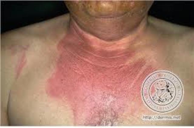 accidente 05 - Therac-25