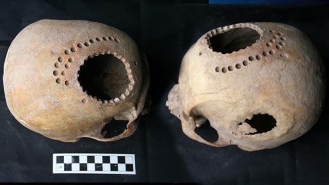 Primeras trepanaciones