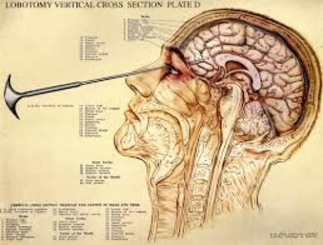 lobotomy
