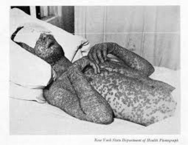 Epidemis of smallpox