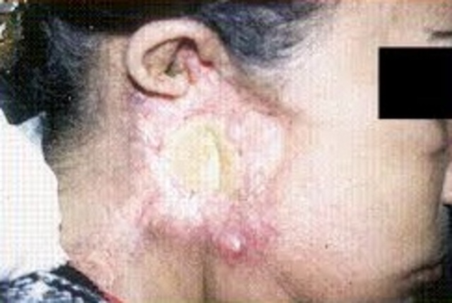 Primer Accidente Therac-25