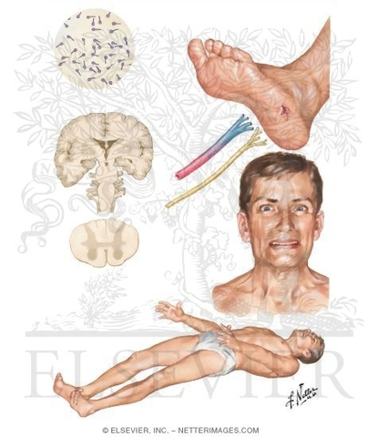 Primera vacuna contra el Tétanos