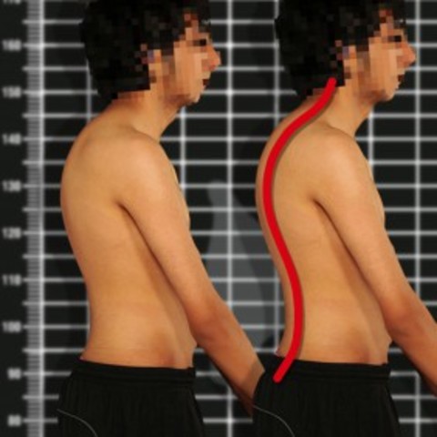 4. előadás Gerinc betegségei: Scheuermann kór, Szerkezeti- struktúrális scoliosis