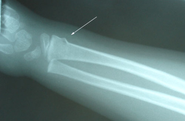 5. előadás Törések fajtái, diagnózis, kezelés, szövődmények