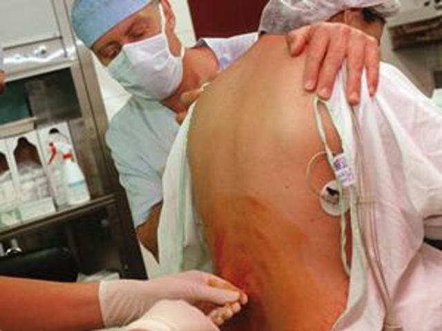 B.- ANALGESIA O NO ANALGESIA?