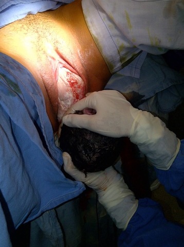 E.- PREVENCIÓN DE HEMORRAGIA