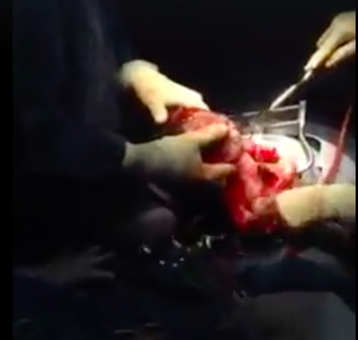 EXTRACCIÓN DEL FETO