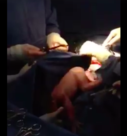 CORTE DEL CORDÓN UMBILICAL