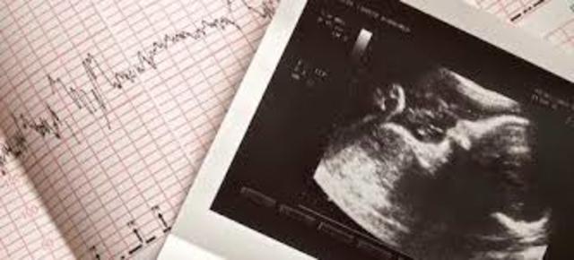 Fusion de pliegues neurales