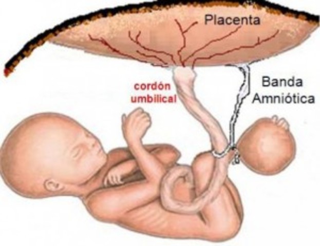 Inserción del cordón umbilical en el centro del abdomen