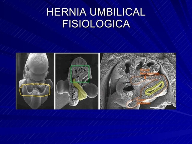 Hernia