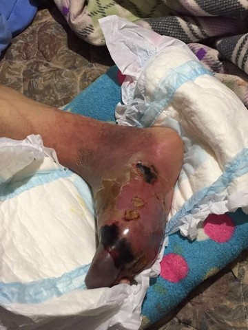 Pie con cambios isquémicos