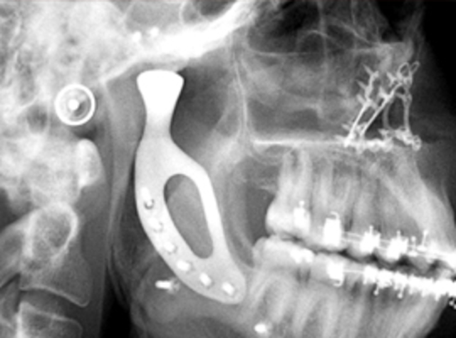 Primer implante de madibula en 3D