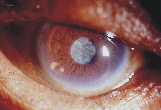 Cirugía de cataratas