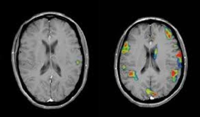 Resonancia magnética funcional (fMRI).