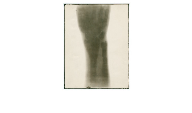 First clinical x-ray performed in America