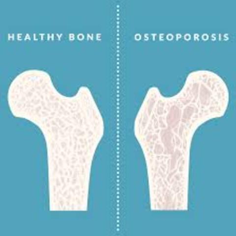 Concern: risk for osteoporosis -bone loss