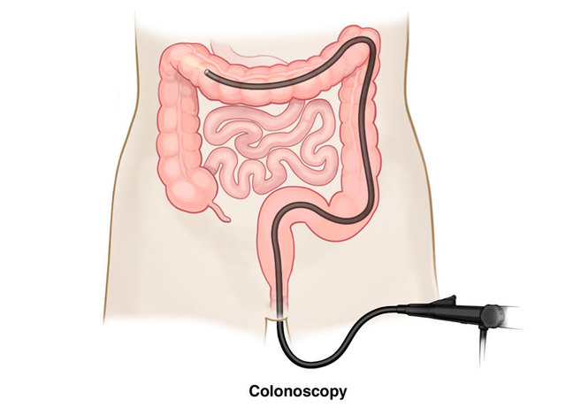 do a colonoscopy