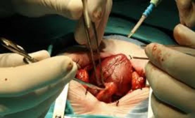 Se realiza el primer trasplante