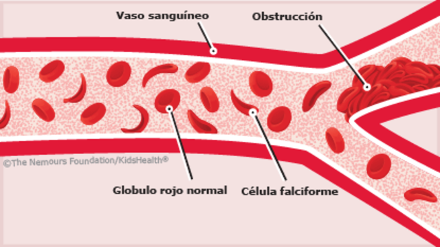 Anemia Falciforme