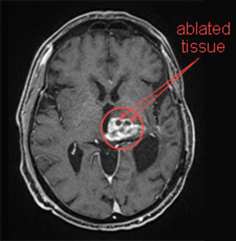 Brain Ablation Experiments