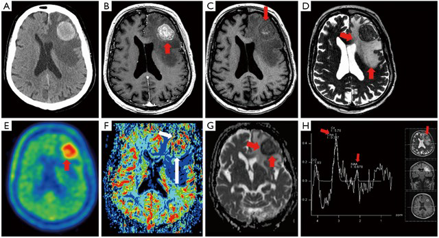 Neuroimaging Techniques