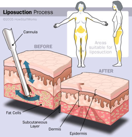 Liposuction – Giorgio Fischer