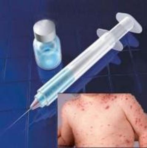 First Vaccine for chicken pox