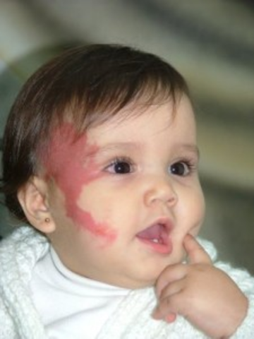 Síndrome de Sturge- Weber/Schirmer