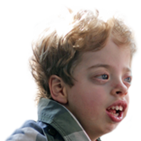 Síndrome de Marshall/ Marshall