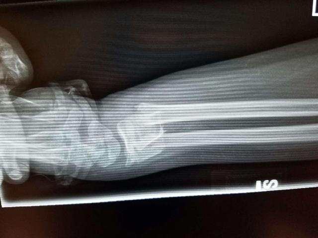 I broke my arm for the 2nd time