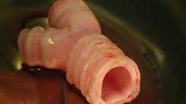 Trachea implant