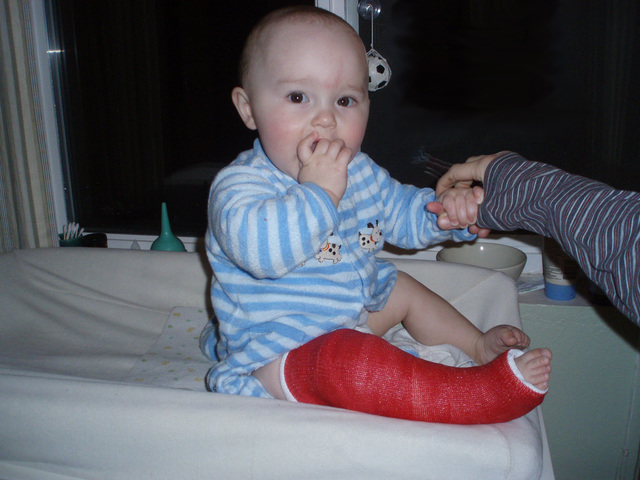 I broke my leg