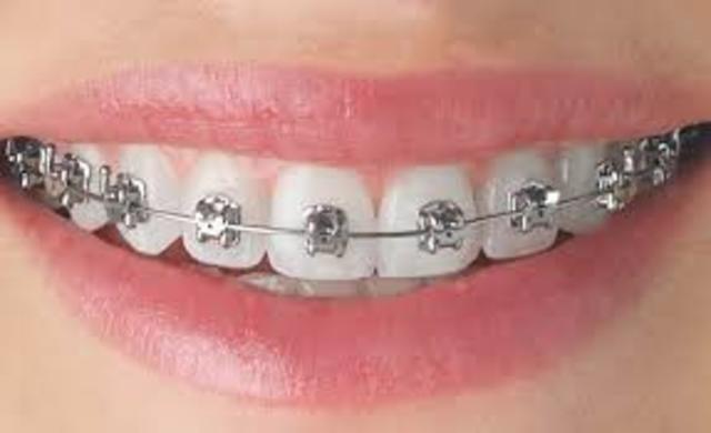 I got braces