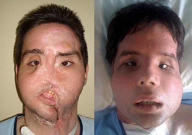 First full-face transplant