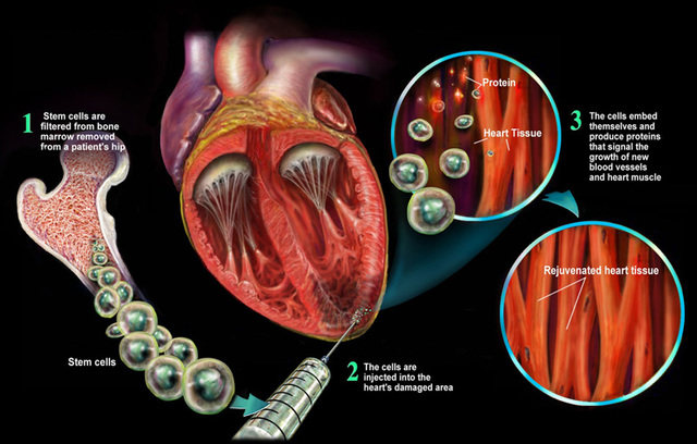 Discovery that patient's stem cells can regenerate heart tissue