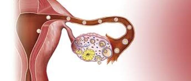 alta producción de Gonadotropina coriónica humana